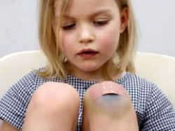 Детский массаж при травмах: растяжениях и ушибах