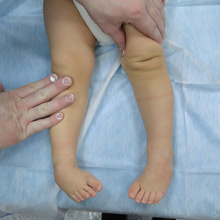 Массаж ребёнку при врождённой косолапости